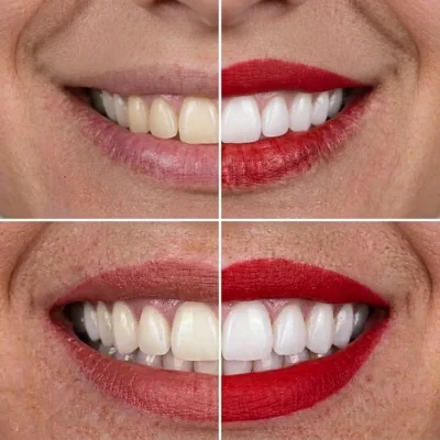 Blanqueamiento dental en Chamberí