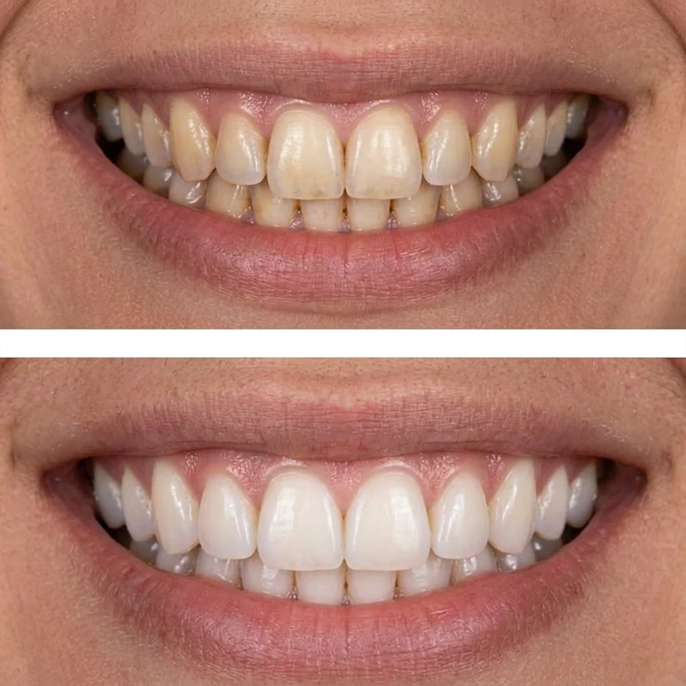 Blanqueamiento dental en Madrid