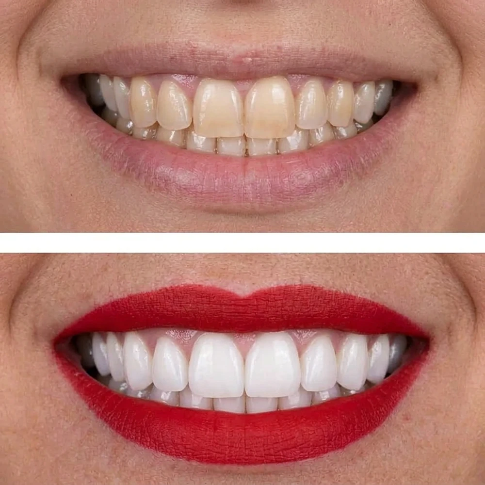 Blanqueamiento dental profesional en Chamberí