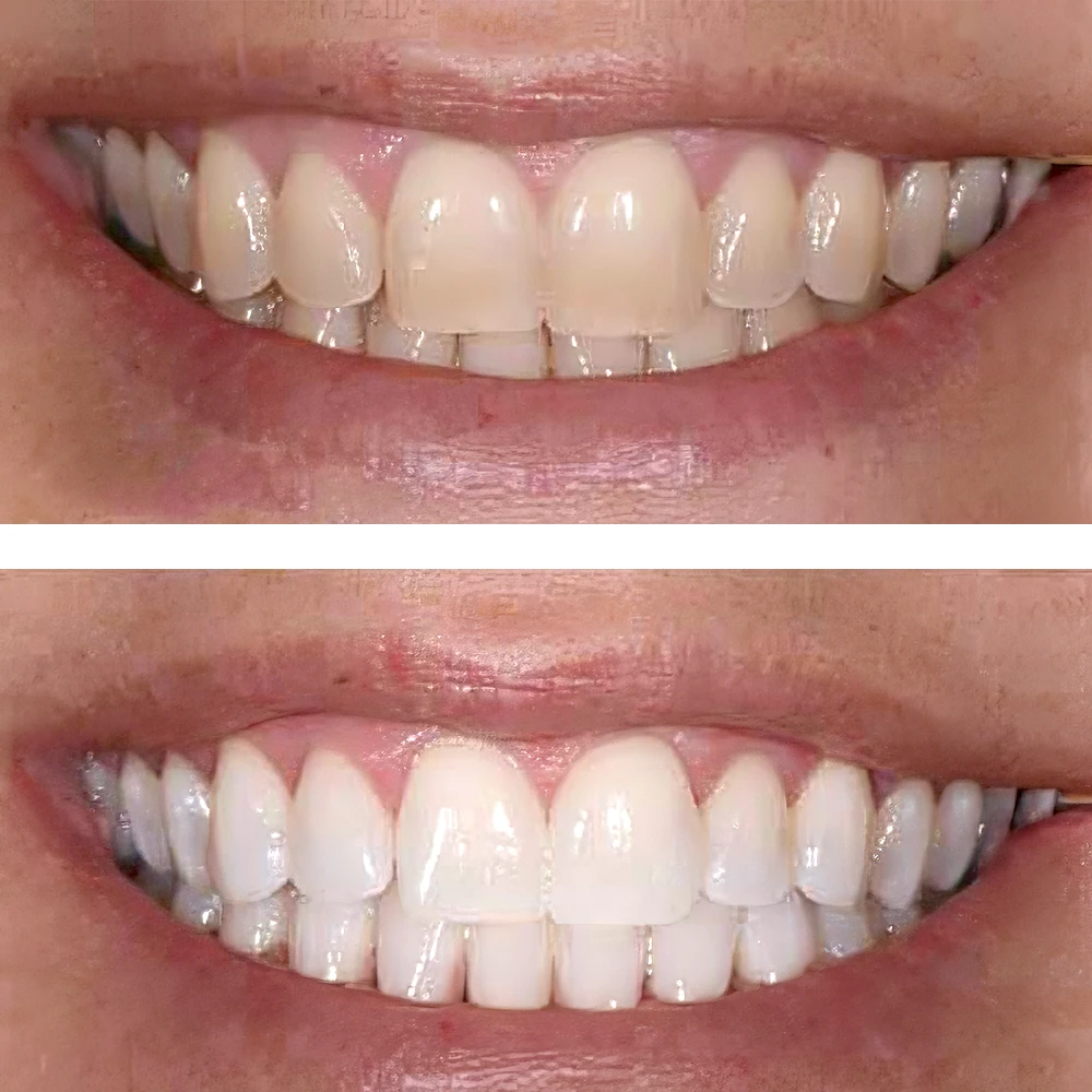 Blanqueamiento dental profesional en Madrid