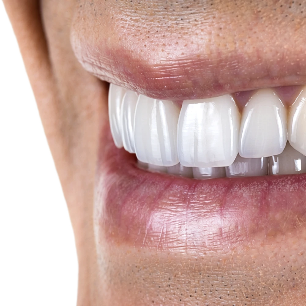 Carillas dentales de porcelana en Madrid