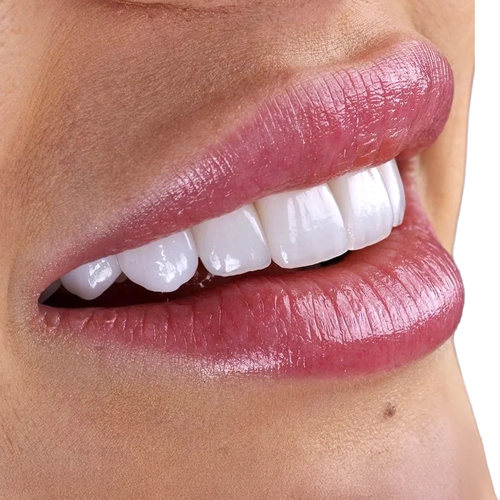 Carillas dentales en Madrid
