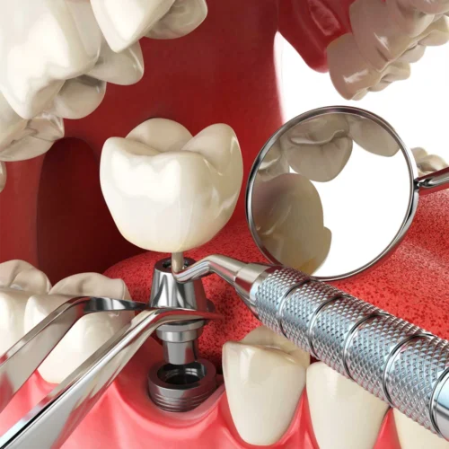 Implantes Dentales en Madrid